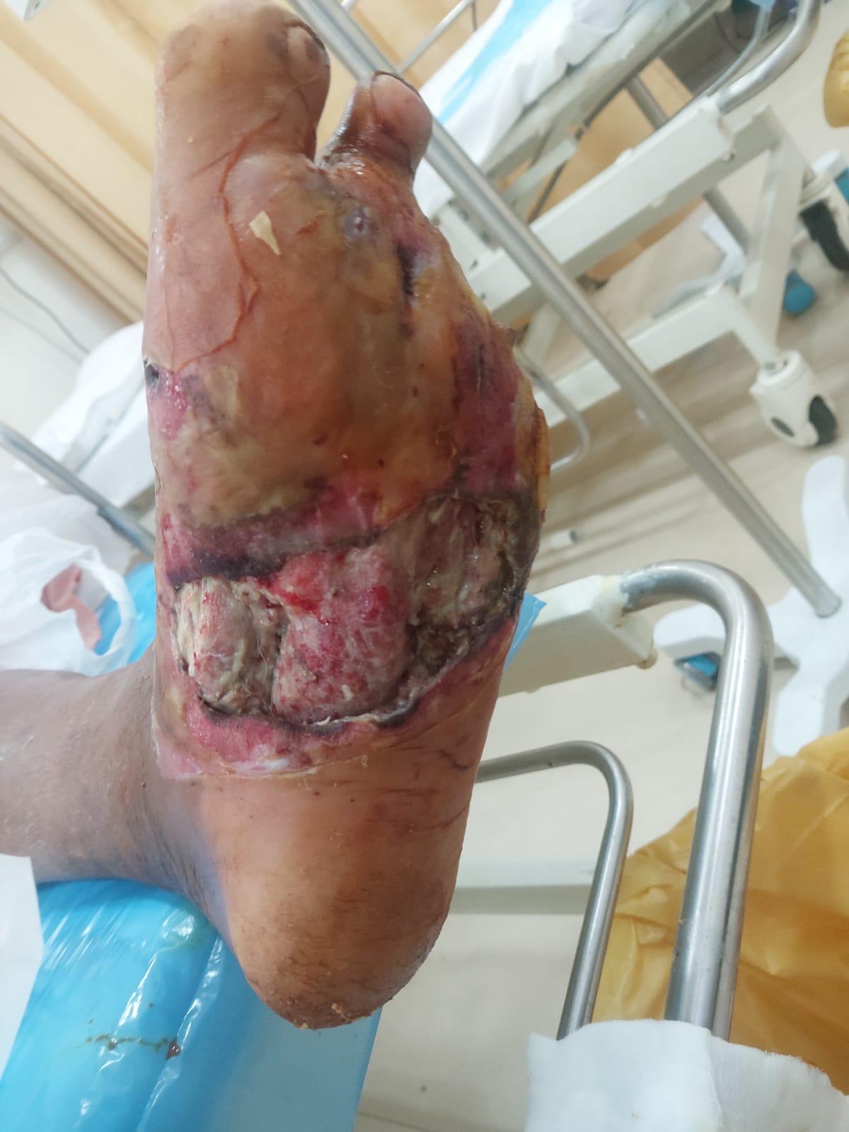 Diabetic Foot Case