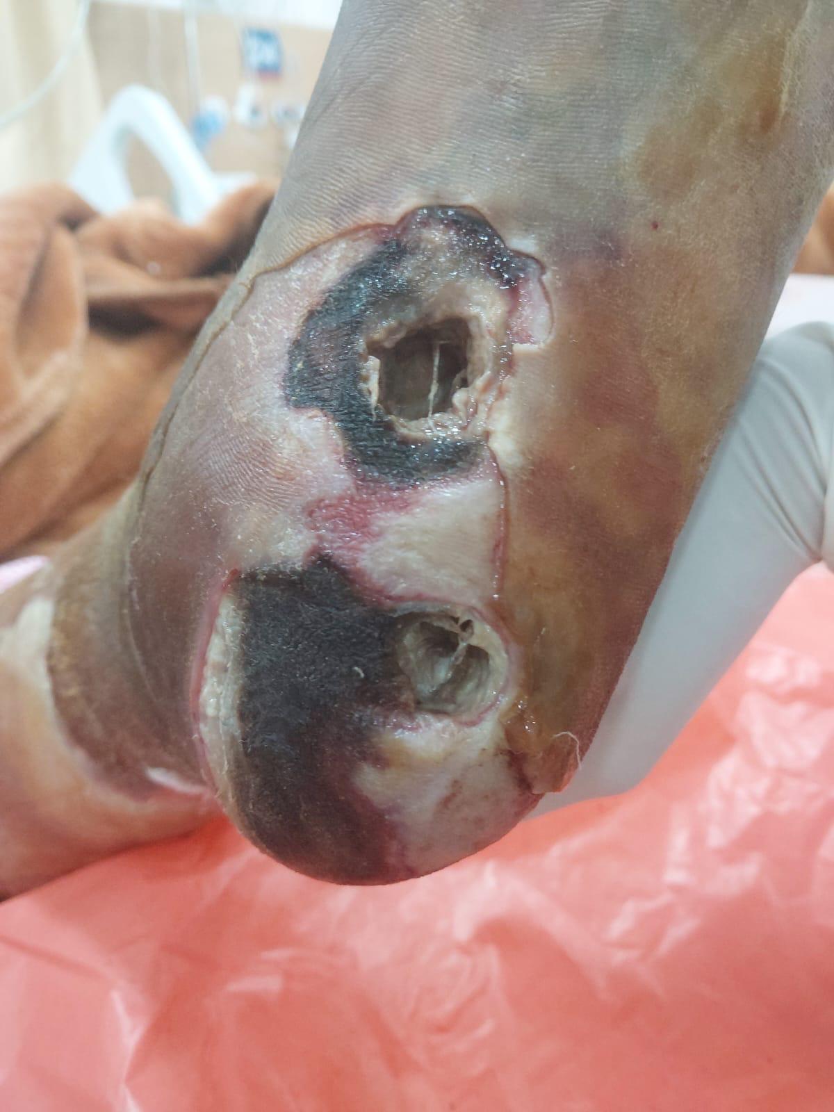 Diabetic Foot Case