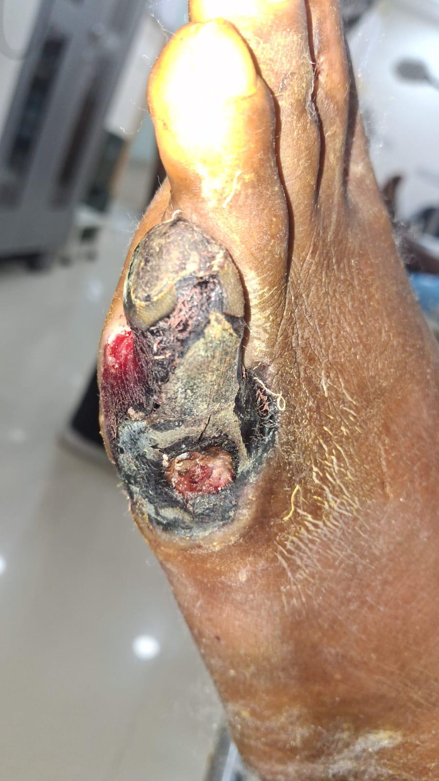 Diabetic Foot Case