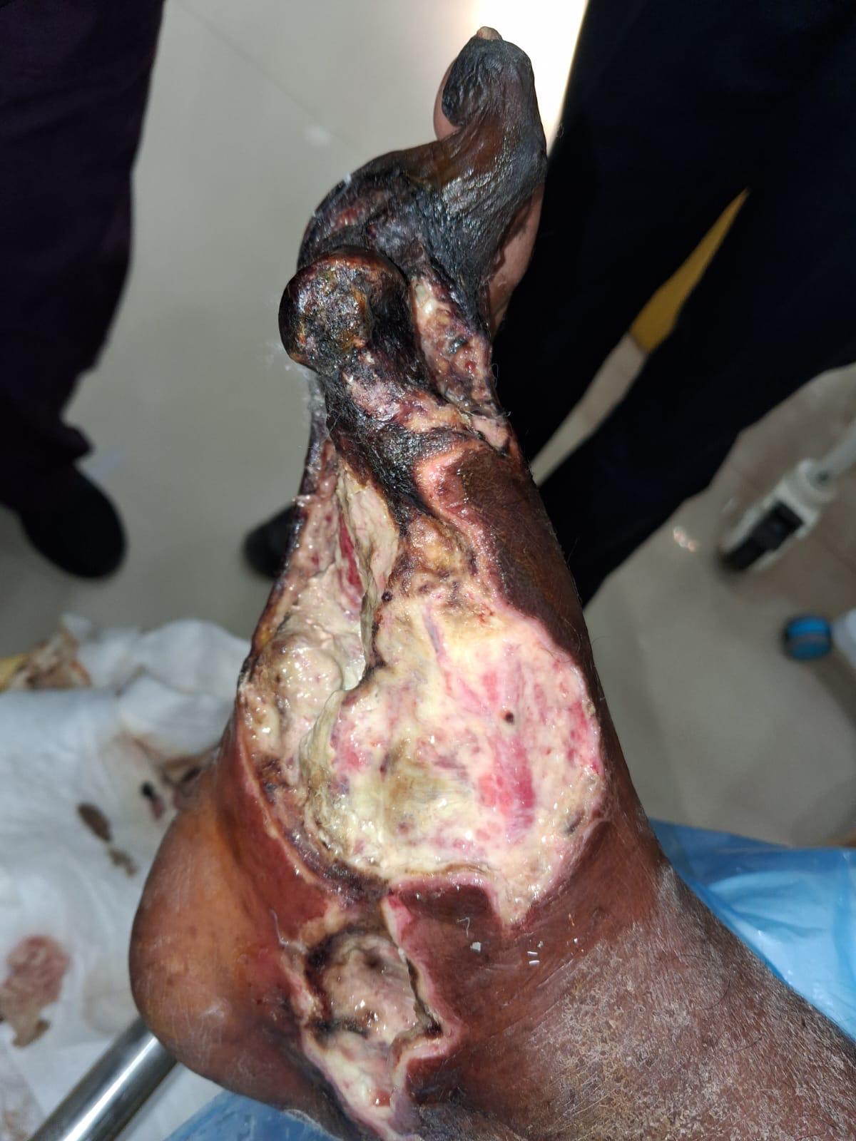 Diabetic Foot Case