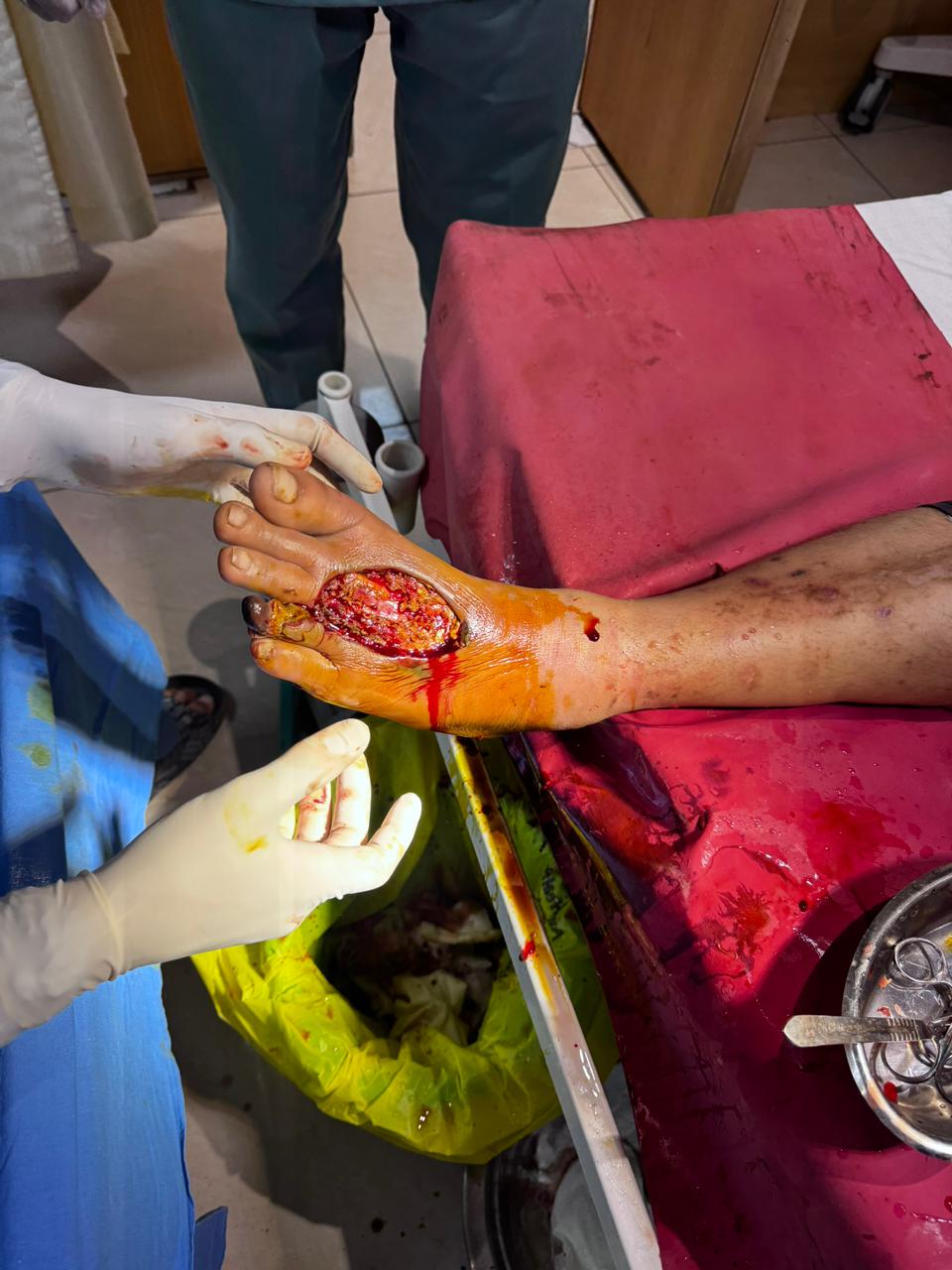 Diabetic Foot Case