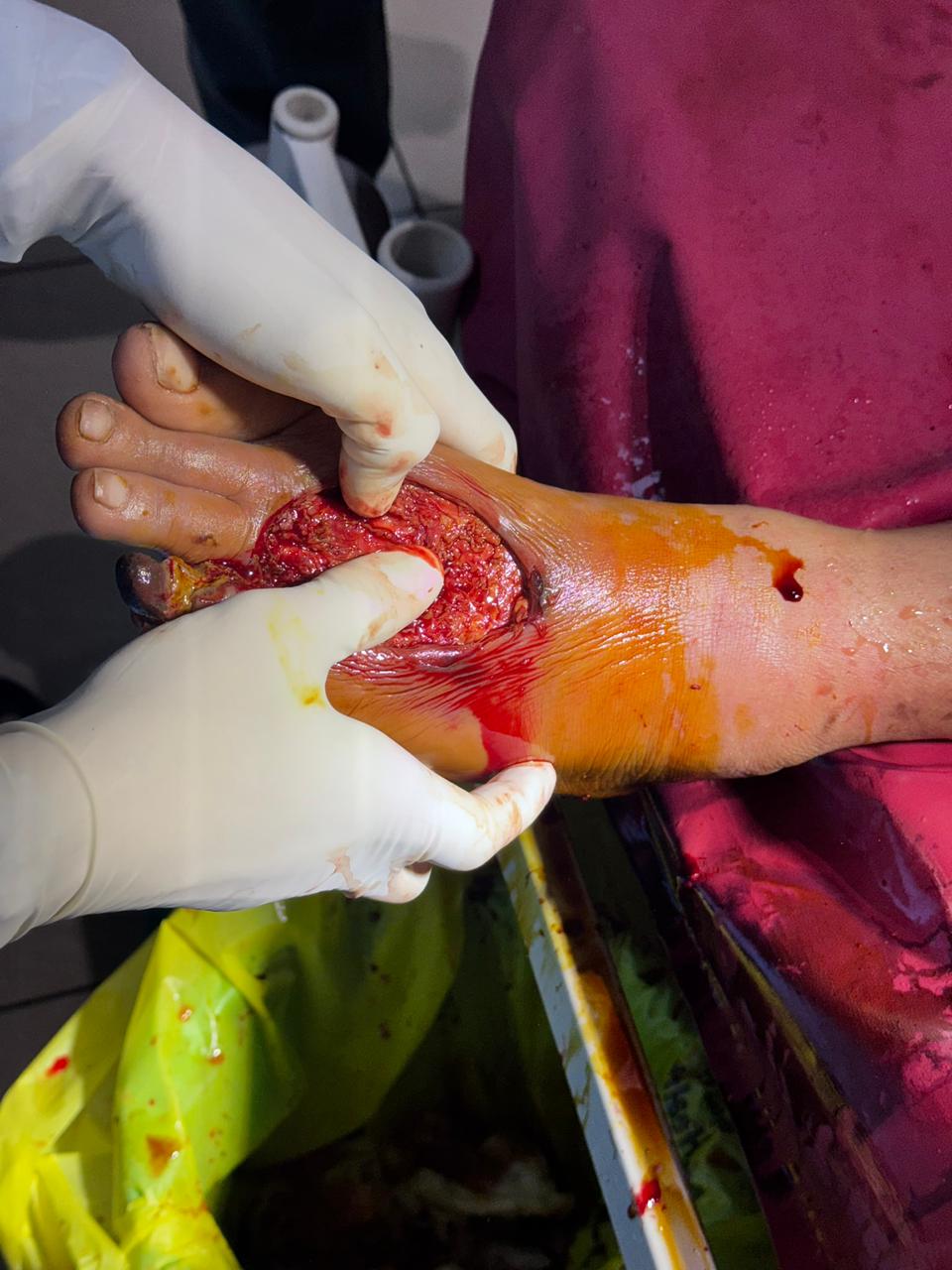 Diabetic Foot Case